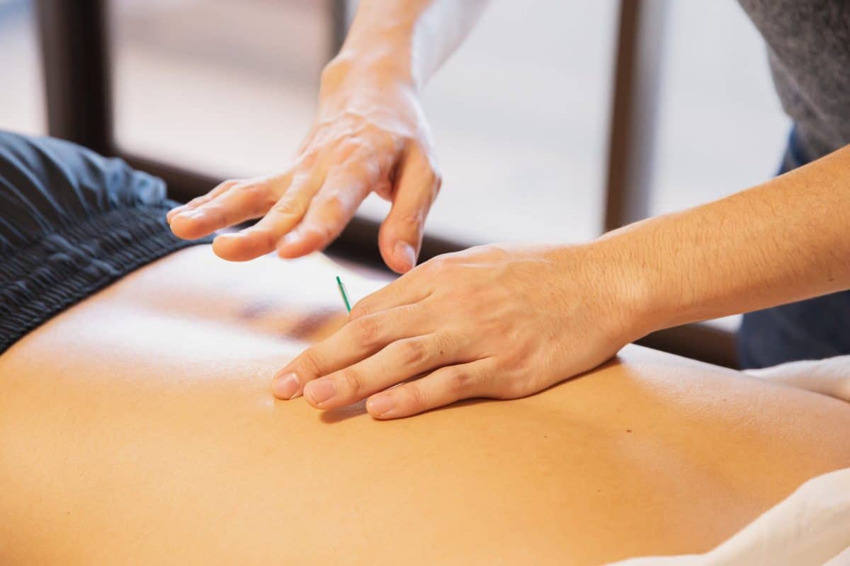 dry needling treatment