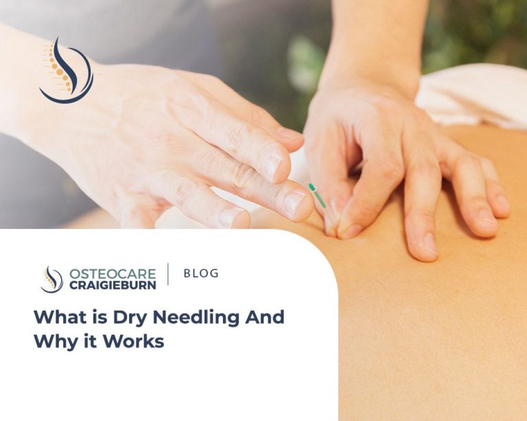 Dry Needling Treatment What it is and Why It Works